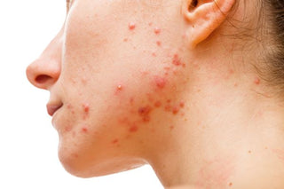 Does Glycolic Acid Clear Acne? Dermatologist Answers.