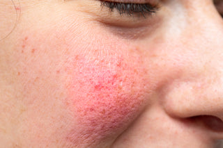 What is Acne Rosacea? The best skin care ingredient to use.