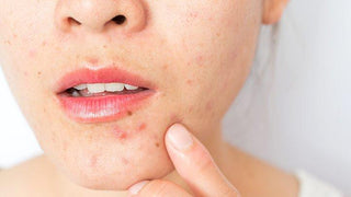 showing acne on face