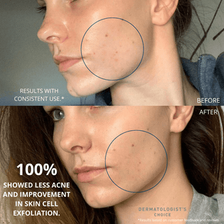 before and after easy Face Cleansing Pads Acne Anti-Aging Dullness Uneven Texture Skin Pigmentation Large Pores