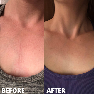 Glycolic Pads Before and After Neck Results