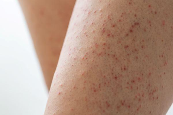 Post Shaving Rash Say Goodbye to Shaving Bumps with Glycolic Acid – Dermatologist's Choice