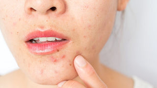 Do this to reduce acne inflammation quickly, according to dermatologists.