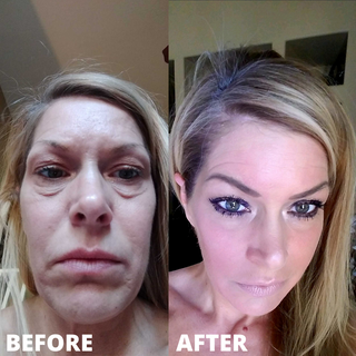 The skin under my eyes is dry and I'm starting to see fine lines, what DermChoice product do I use to improve the moisture and smooth fine lines?