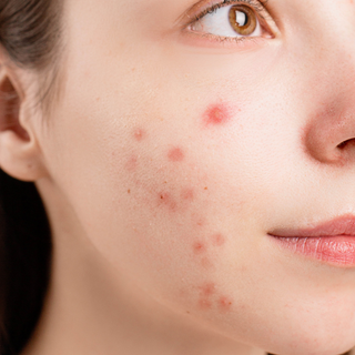 Causes of acne, different types of acne, and the treatment of acne with Glycolic Acid