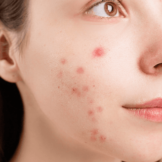 Causes of acne, different types of acne, and the treatment of acne with Glycolic Acid