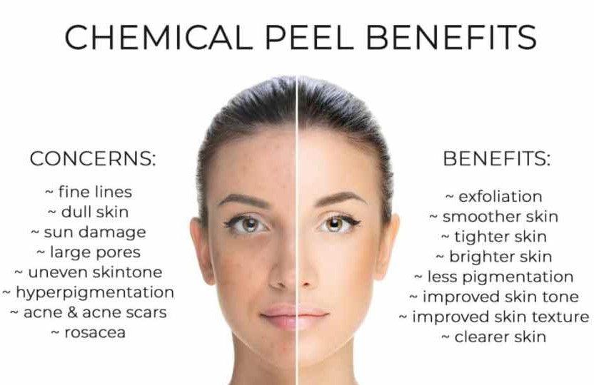 Chemical Peels Benefits Chemical Peels Benefits