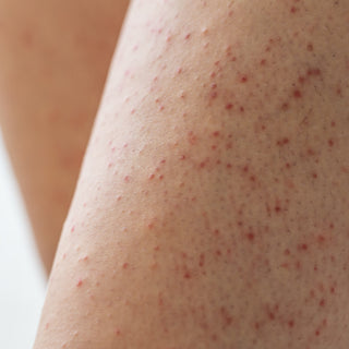 Best Keratosis Pilaris (KP) Skin Solution According to Dermatologists