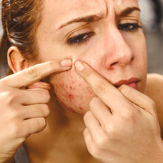 What is the best acne treatment?