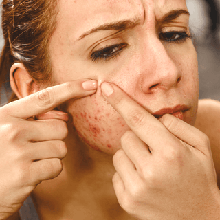 Is Glycolic Acid a Good Acne Treatment?