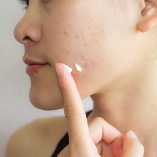 What's Benzoyl Peroxide? Why you need it for acne-prone skin.